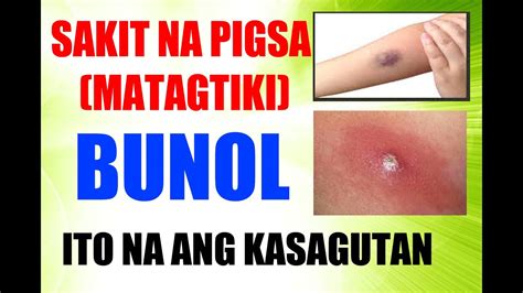 matag tiki tambal|PIGSA: Lunas, Gamot at Health Tips .